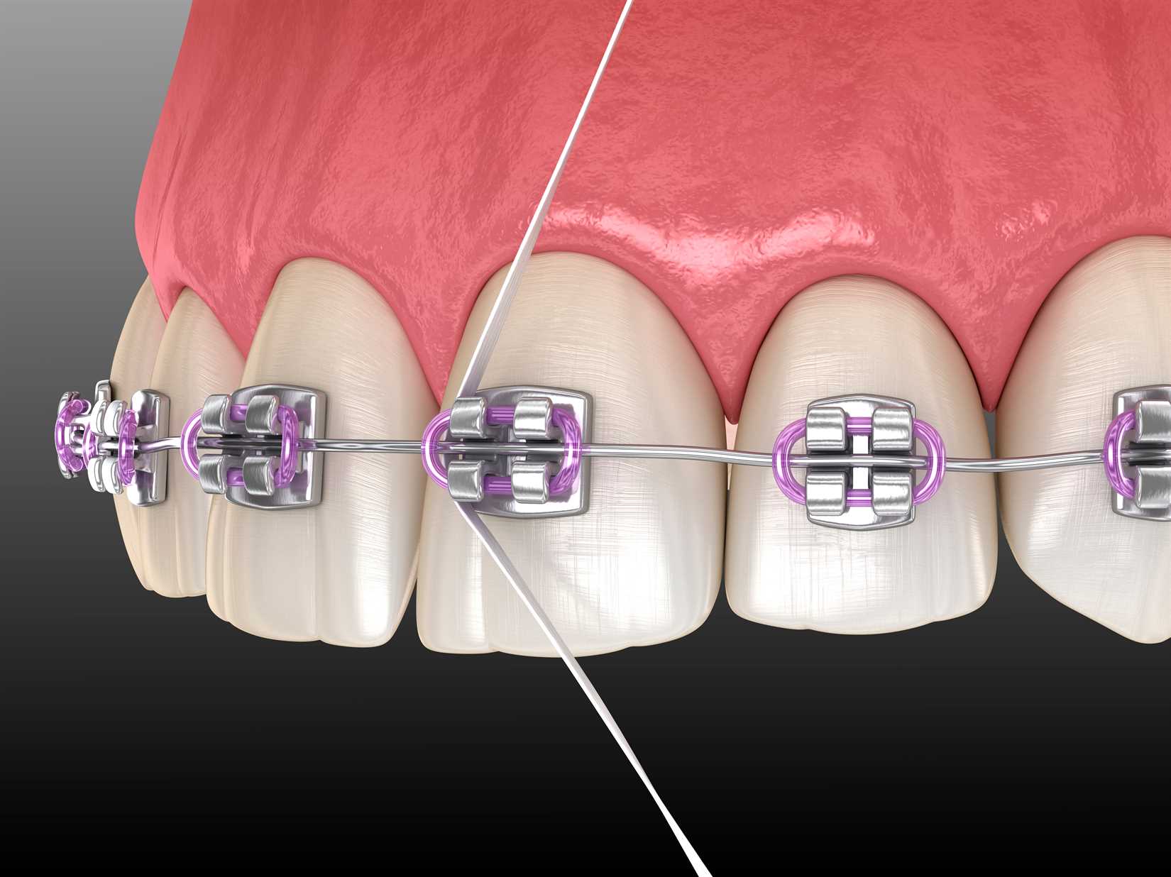 Dental floss cleaning braces process. Dental 3D illustration of oral hygiene.