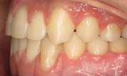Patient1-after-bottom3