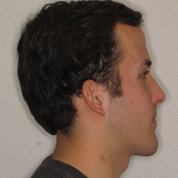 Patient1-after-top3