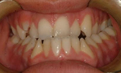 Patient1-before-bottom2