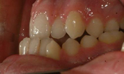 Patient1-before-bottom3