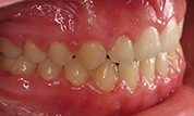 Patient13d-after-bottom1