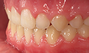 Patient13d-after-bottom3