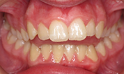 Patient13d-before-bottom2