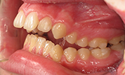 Patient13d-before-bottom3