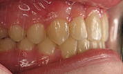 Patient14d-after-bottom1