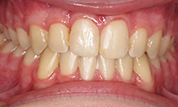 Patient14d-after-bottom2