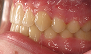 Patient14d-after-bottom3