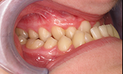 Patient14d-before-bottom1