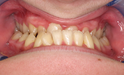 Patient14d-before-bottom2