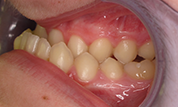 Patient14d-before-bottom3