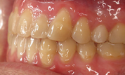 Patient2-after-bottom3