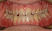 Patient2-before-bottom2