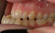 Patient2-before-bottom3