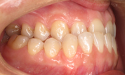 Patient4-before-bottom1