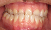 Patient4-before-bottom2
