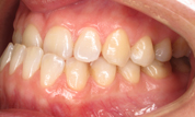 Patient4-before-bottom3