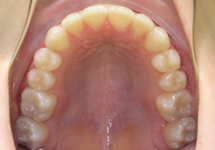 arch-after-22b