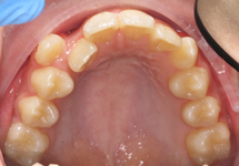 arch-before-11b