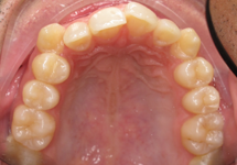 arch-before-15b