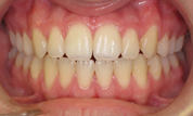 gallery-patient-01c-after-center