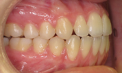 gallery-patient-01c-after-left