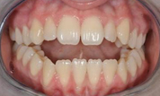 gallery-patient-01c-before-center