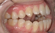 gallery-patient-01c-before-left
