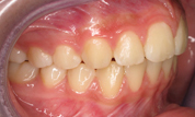 gallery-patient-05c-after-left