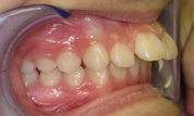 gallery-patient-09c-before-left