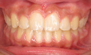 gallery-patient-10c-after-center