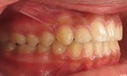 gallery-patient-10c-after-left