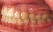 gallery-patient-10c-after-right