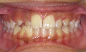 gallery-patient-10c-before-center