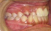 gallery-patient-10c-before-left