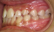 gallery-patient-10c-before-right