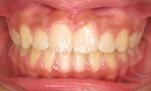 gallery-patient-11a-after