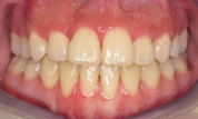 gallery-patient-11c-after-center