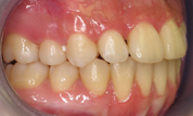 gallery-patient-11c-after-left