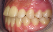 gallery-patient-11c-after-right