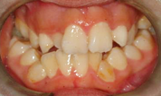 gallery-patient-11c-before-center