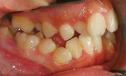 gallery-patient-11c-before-left