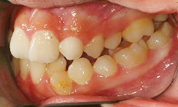 gallery-patient-11c-before-right