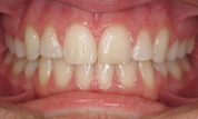 gallery-patient-12c-after-center