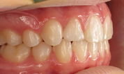 gallery-patient-12c-after-left