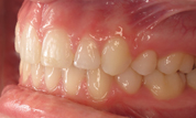 gallery-patient-12c-after-right