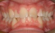 gallery-patient-12c-before-center
