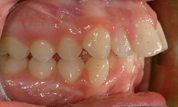 gallery-patient-12c-before-left