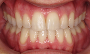 gallery-patient-13c-after-center