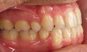 gallery-patient-13c-after-left